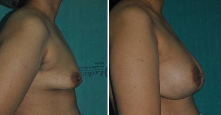 Breast implant surgery in Kerala
